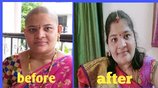 #Gundu#1sttimeGundustory#tirumalagundu Gundu|Gundu journey |After Gundu hairgrowth |Gundu experience