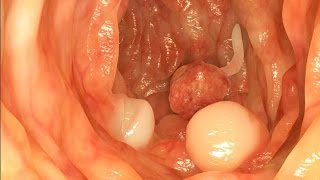 Mayo Clinic Minute: Colonoscopy