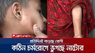 নাটোরের এক গ্রামে চর্ম রোগের আছর! পাশে নেই স্বাস্থ্য বিভাগ!| Natore Skin Disease | Jamuna TV