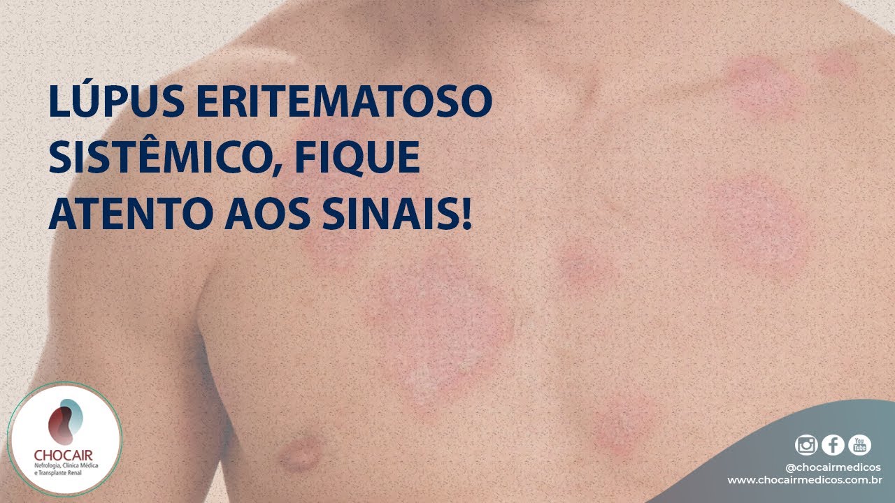 Lúpus Eritematoso Sistêmico, Fique Atento Aos Sinais! | Chocair Médicos ...