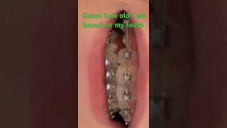 Brace Face