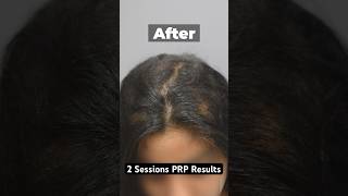 PRP Results Before & After 2 Sessions  #prptreatment #hairlosstreatment