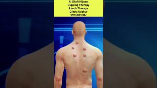 3D Animation Cupping therapy how its work