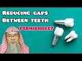 Is closing gaps between teeth permissible? - Assim al hakeem