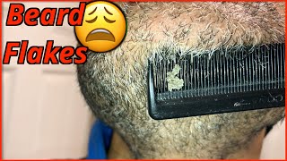 The Never Ending Flake Routine 😩| DANDRUFF FLAKES | SEBORRHEIC DERMATITIS | PitaFlakes