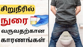 சிறுநீரில் நுரை வருவதற்கான காரணங்கள் | Causes And Symptoms Of Proteinuria in Tamil