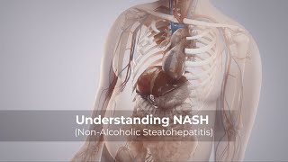 Understanding NASH (Non-Alcoholic Steatohepatitis)
