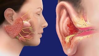 Swollen Preauricular Lymph Nodes: Causes And Treatment
