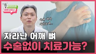 60대 남성 어깨충돌증후군, 비수술로 회복이 가능할까? | mri, 증상, 원인