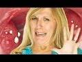 What Are Tonsil Stones? What Are Tonsil Stones?
