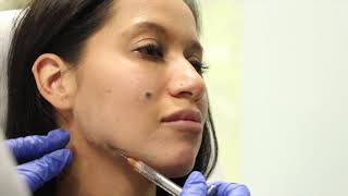 Restylane Filler Injections on the Jawline with Dr. Boen