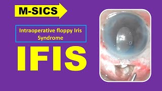 MSICS // Case of IFIS // Cataract Surgery // Dr.Rakesh Koli ,RIMS,Raichur.