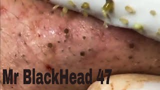 Mr Blackheads Remover best scen in 2019 No 47