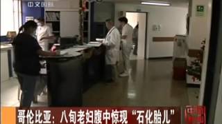 悚！8旬老婦腹痛 胎死腹中40年變石頭嬰屍