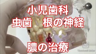 １８）小児子供　虫歯と根の膿ニキビの治療方法　 痛い　噛めない　大宮　鈴木歯科医院