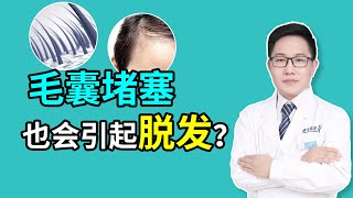 【毛发问题】毛囊堵塞会直接导致脱发吗？大部分人是脂溢性脱发！雍禾植发|马晓阳医师