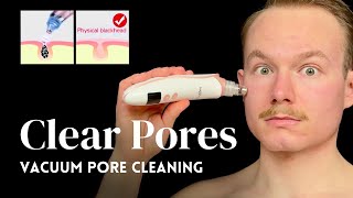 Blackhead Vacuum Pore Cleaning: Remove Blackheads \u0026 Improve Skin Texture Safely | Step-by-Step Guide