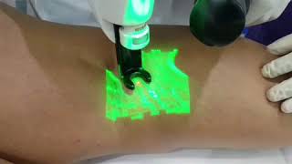 Laser Treatment of Spider Veins (CLaCS) - Video 1
