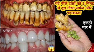 गंदे पीले दांतों को 5 मिनट में दूध जैसा सफेद और चमकदार बना देगा ये तरीका | teeth whitening remedy