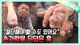 손부터 발까지, 온몸을 뒤덮은 종양…그래도 아저씨가 다시 일어서는 이유┃ From Fingers to Toes.. He's Covered with Tumors But,