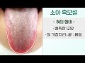 흑모설 아이 혀가 새까매졌어요. 혀백태가 검은색이 됐어요