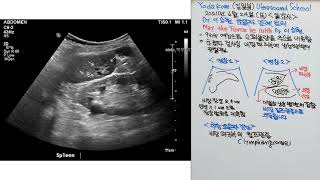 Yoda Kim Ultrasound School(1385) - Dr.이승현 증례. 비장 하극의 림프관종