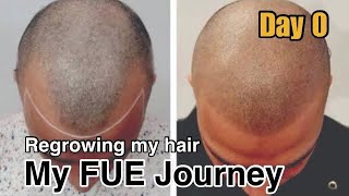 Scalp Micropigmentation in the Philippines | FUE Hair Transplant journey | VLOG 1