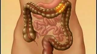 How irritable bowel syndrome affects you