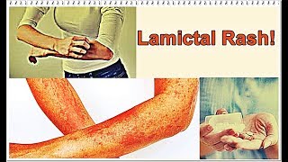 Lamictal Rash – Symptoms, Treatment