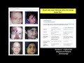 radiological differential diagnosis of congenital head u0026 neck tumors lecture for the eshnr 2022