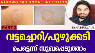 Ringworm Malayalam/How to treat ringworm infection/ വട്ടച്ചൊറി/പുഴുക്കടി/ by Dr.Hasbulla Part 2