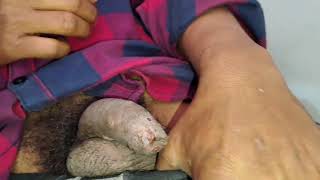 phimosis treatment | penis foreskin infection | genital itching(खुजली)| scabies  skin rashes | लिंग