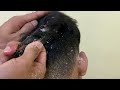 dry scalp big flakes dandruff scratching satisfying video 807