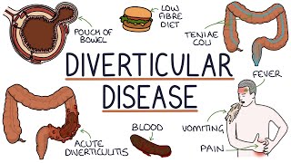 Understanding Diverticulosis and Diverticulitis