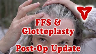 Post-Op Day 44 Facial Feminization Surgery — 1 Month Post-Op for Trans Glottoplasty — FFS Part 15