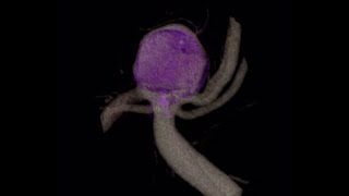 Aneurysm Basilar Top - WEB