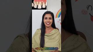 പല്ലിനു ഒരു മുഖം മൂടി ഇട്ടാലോ... Ceramic Dental Shell For Beautiful Teeth #dentalveneers