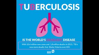 Classification of tuberculosis Using Deep Learning