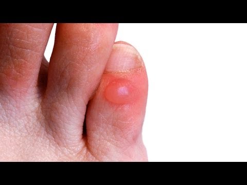 How to Prevent & Treat Foot Blisters | Foot Care How to Prevent & Treat Foot Blisters | Foot Care