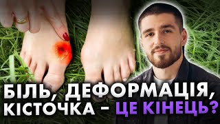 БІЛЬ, ДЕФОРМАЦІЯ, ЖАХ! КІСТОЧКА НА НОЗІ… Але її можна ПОЗБУТИСЯ НАЗАВЖДИ!