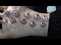 sliding cupping to alleviate back pain