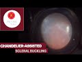 Chandelier assited Scleral Buckling for Rhegmatogenous Retinal Detachment