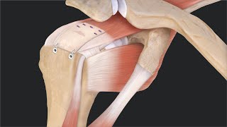 CuffMend™ Rotator Cuff Augmentation System