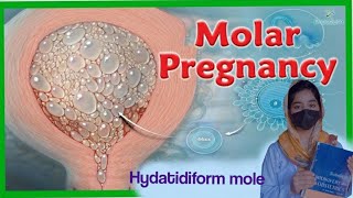 Hydatidiform mole--molar pregnancy.