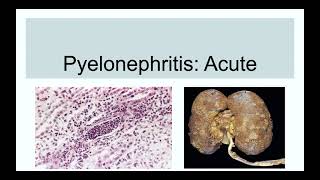Pyelonephritis( Acute)