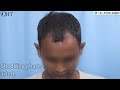 hair transplant in india 2021 nw grade ii 1 647 grafts @regrow clinic ​