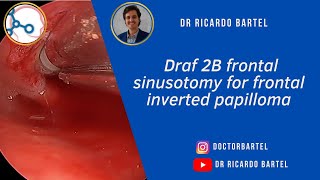 Draf 2B frontal sinusotomy for frontal sinus inverted papilloma