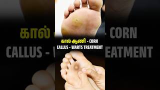 கால் ஆணி 💯 result - Kaal aani குணப்படுத்த இதை பயன்படுத்தவும் | Foot Corn, callus \u0026 warts Treatment