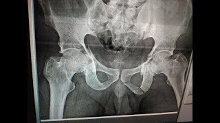 Acetabulum Percutaneous technique - Dr Ramprasad K MS(ORTHO) AIIMS, FAOA (AUS) A1 ORTHOCARE