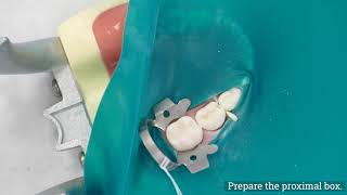 Class II Amalgam on Primary Molars - Description shows UofU SOD D4 students involved.